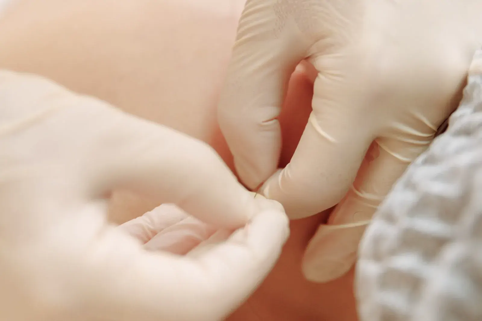 Gloved hands placing an acupuncture needle during a treatment session
