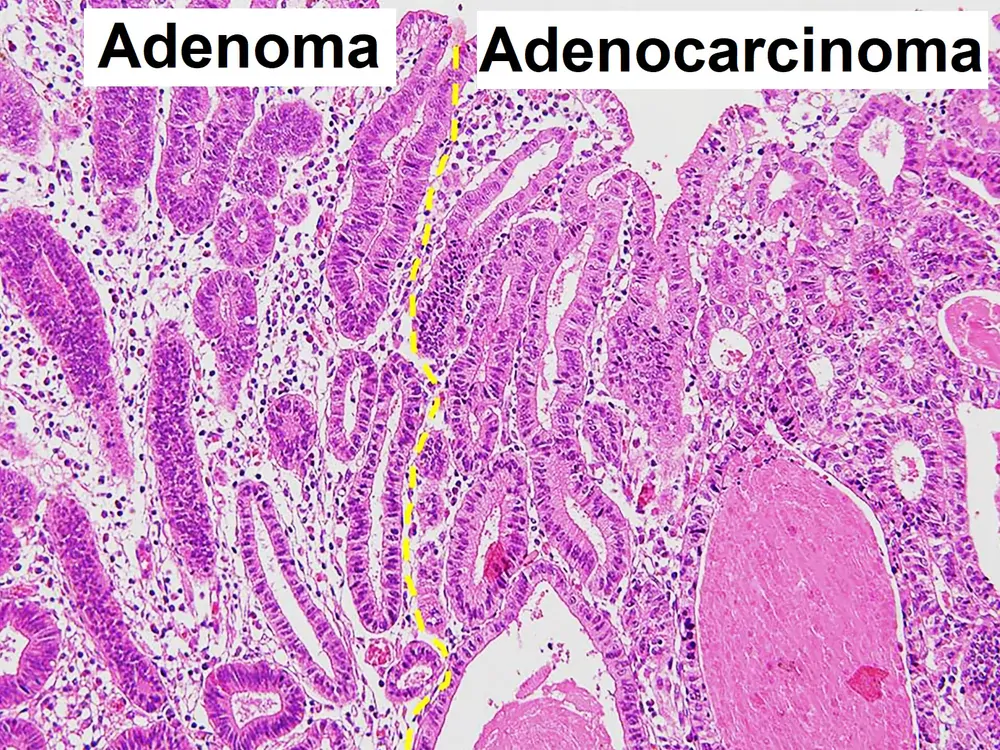 Mikrograf adenoma dan adenokarsinoma lambung dengan label Inggris menunjukkan kedua jaringan